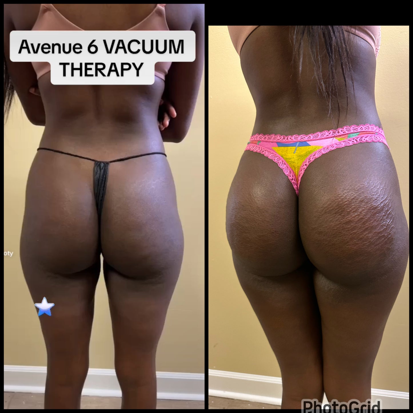 Vacuum Therapy/ Breast Therapy